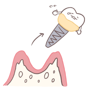 支えの骨を失って抜け落ちるインプラントのイラスト