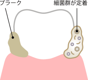 歯に付いたプラークと定着した細菌群のイラスト