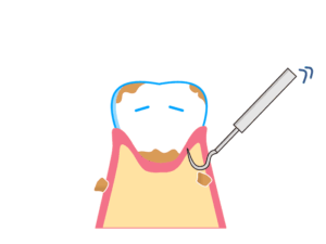 歯科用スケーラーで歯石を取り除くイラスト