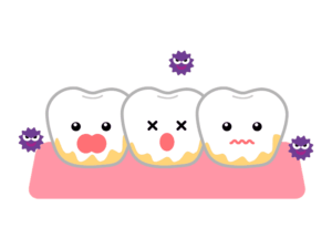 歯石が付いて細菌が増えた歯のイラスト
